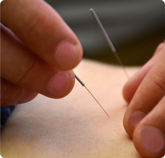 A chiropractitioner displaying Dry Needling